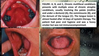 FIGURE: A, B, and C, Chronic multifocal candidiasis
presents with multiple areas of chronic atrophic
candidiasis, usually involving the palate (midline
and under a denture) (A), the commissures (B), and
the dorsum of the tongue (C). The tongue lesion is
almost healed after 14 days of nystatin therapy. The
patient had poor oral hygiene and was a heavy
smoker but was not immunocompromised.A
B C 40
 