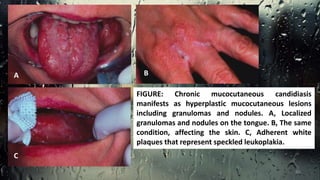 FIGURE: Chronic mucocutaneous candidiasis
manifests as hyperplastic mucocutaneous lesions
including granulomas and nodules. A, Localized
granulomas and nodules on the tongue. B, The same
condition, affecting the skin. C, Adherent white
plaques that represent speckled leukoplakia.
A
C
B
46
 