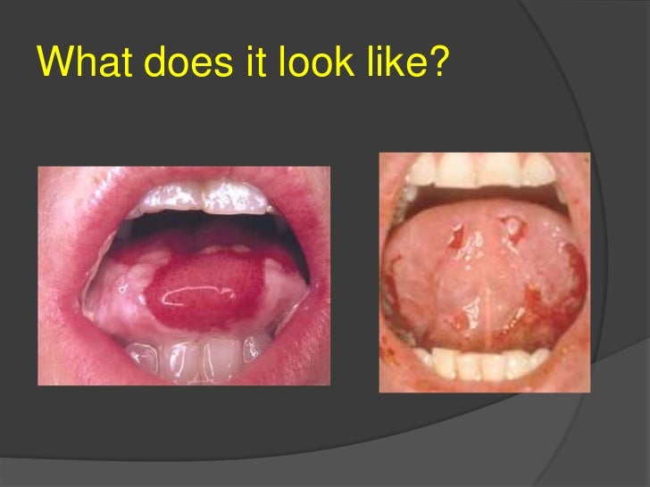 oral-care-for-cancer-patients-power-point-64-728.jpg?cb=1306259839