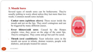 182520290033
10
3. Mouth Sores
Several types of mouth sores can be bothersome. They're
usually nothing to worry about unless they last more than two
weeks. Common mouth sores include:
 Canker sores (aphthous ulcers): These occur inside the
mouth and not on the lips. They aren't contagious and can
be triggered by many different causes.
 Fever blisters/cold sores: Caused by the Herpes
simplex virus, they occur on the edge of the outer lips.
They're contagious. They come and go but can't be cured.
 Thrush (oral candidiasis): Yeast infection sores in the
mouth can occur in infants, denture wearers, people with
diabetes, and people treated for cancer.
 