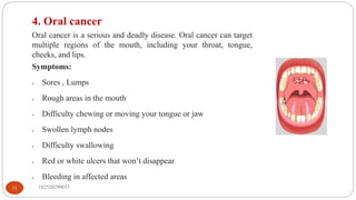 182520290033
11
4. Oral cancer
Oral cancer is a serious and deadly disease. Oral cancer can target
multiple regions of the mouth, including your throat, tongue,
cheeks, and lips.
Symptoms:
 Sores , Lumps
 Rough areas in the mouth
 Difficulty chewing or moving your tongue or jaw
 Swollen lymph nodes
 Difficulty swallowing
 Red or white ulcers that won’t disappear
 Bleeding in affected areas
 