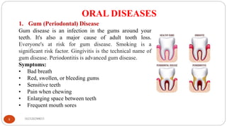 ORAL DISEASES
182520290033
8
1. Gum (Periodontal) Disease
Gum disease is an infection in the gums around your
teeth. It's also a major cause of adult tooth loss.
Everyone's at risk for gum disease. Smoking is a
significant risk factor. Gingivitis is the technical name of
gum disease. Periodontitis is advanced gum disease.
Symptoms:
• Bad breath
• Red, swollen, or bleeding gums
• Sensitive teeth
• Pain when chewing
• Enlarging space between teeth
• Frequent mouth sores
 