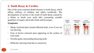 182520290033
9
2. Tooth Decay & Cavities
One of the most common dental diseases is tooth decay, which
affects millions of children and adults worldwide. The
development of cavities is the result of tooth decay caused by
a failure to brush your teeth after consuming sizeable
quantities of sugary and acidic foods and beverages.
Symptoms:
• Sharp, localized pain around affected teeth, even if you are
not chewing
• Grey or brown coloured spots appearing on the surface of
your teeth
• Swollen gums surrounding decaying teeth
• Difficulty chewing food due to sensitivity
 