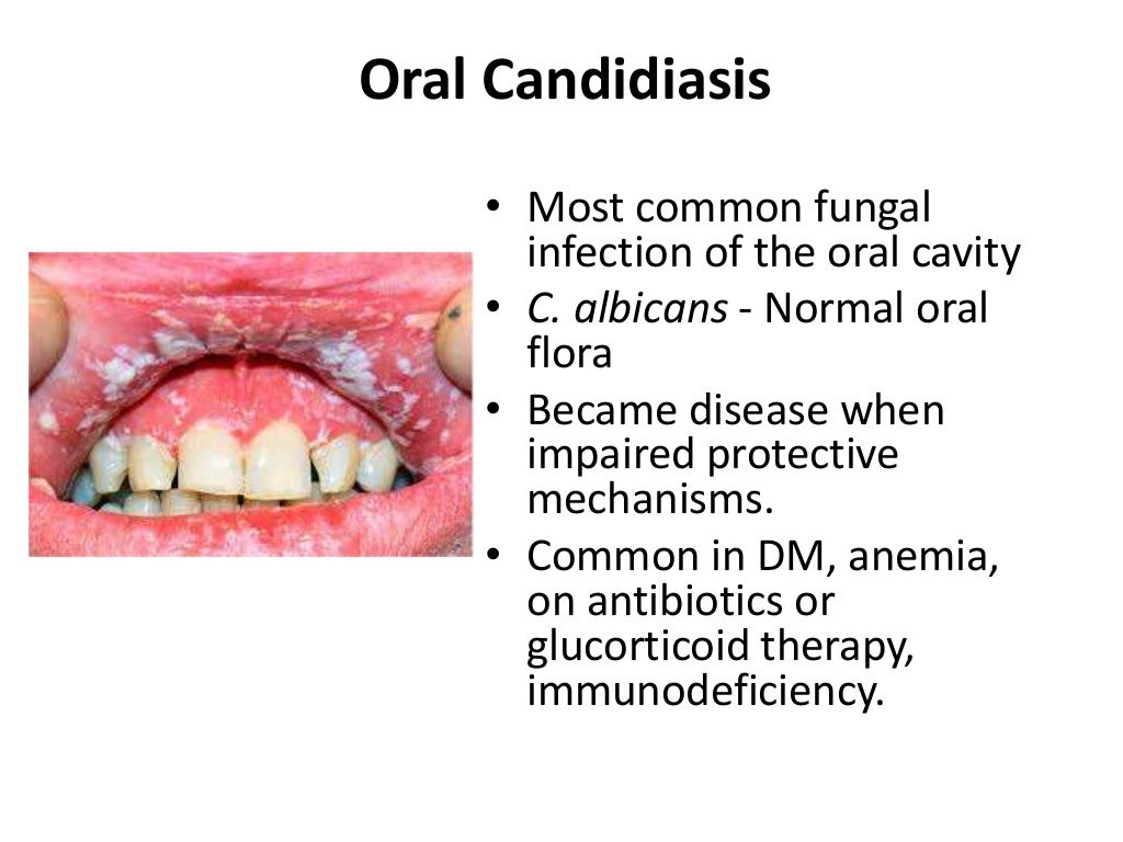 Oral cavity and salivary gland diseases