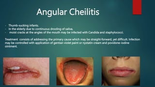 Ahmed Al Abbasi/ Oral Cavity and Tongue diseases, | PPTX