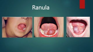 Ahmed Al Abbasi/ Oral Cavity and Tongue diseases, | PPTX