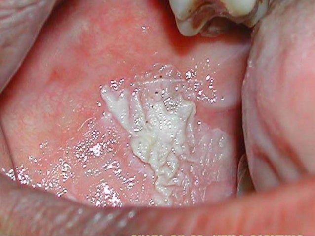 Oral cavity cancer