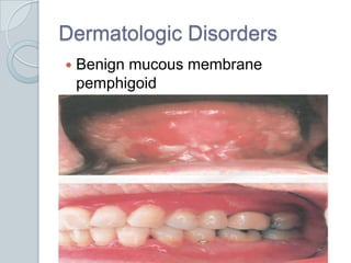 Dermatologic DisordersBenign mucous membrane pemphigoid
