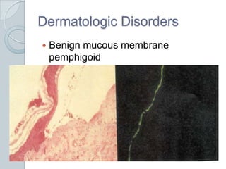 Dermatologic DisordersBenign mucous membrane pemphigoid