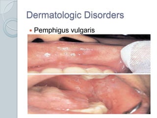 Dermatologic DisordersPemphigus vulgaris