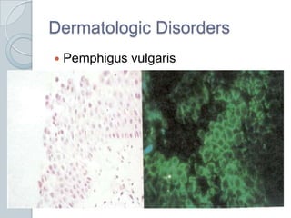 Dermatologic DisordersPemphigus vulgaris