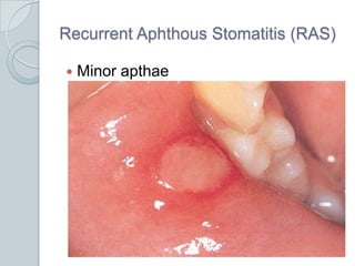 Recurrent Aphthous Stomatitis (RAS)Minor apthae
