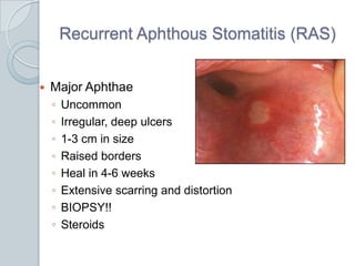 Recurrent Aphthous Stomatitis (RAS)Major AphthaeUncommonIrregular, deep ulcers1-3 cm in sizeRaised bordersHeal in 4-6 weeksExtensive scarring and distortionBIOPSY!!Steroids