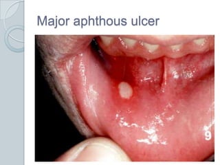 Major aphthous ulcer