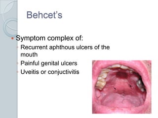 Behcet’sSymptom complex of:Recurrent aphthous ulcers of the mouthPainful genital ulcersUveitis or conjuctivitis