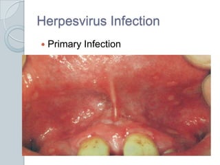 Herpesvirus InfectionPrimary Infection