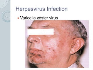 Herpesvirus InfectionVaricella zoster virus