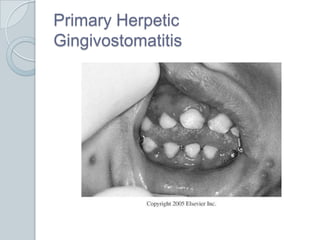 Primary Herpetic Gingivostomatitis