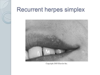 Recurrent herpes simplex