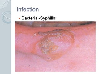 InfectionBacterial-Syphilis
