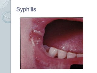 Syphilis