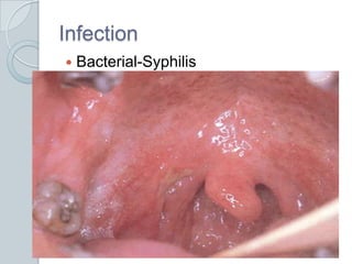 InfectionBacterial-Syphilis