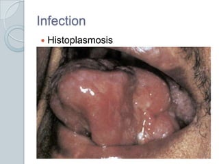 InfectionHistoplasmosis