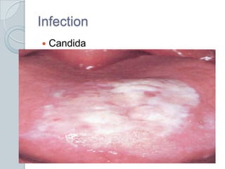 InfectionCandida