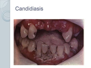 Candidiasis
