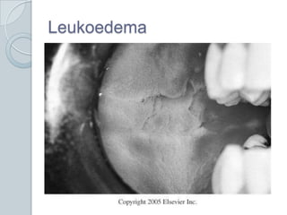 Leukoedema