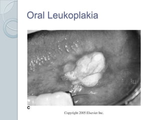 Oral Leukoplakia