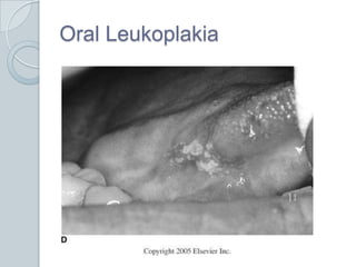Oral Leukoplakia