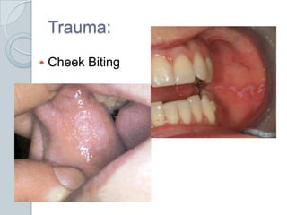 Trauma:Cheek Biting