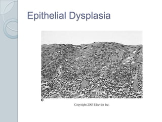 Epithelial Dysplasia