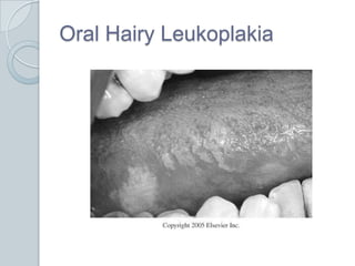 Oral Hairy Leukoplakia