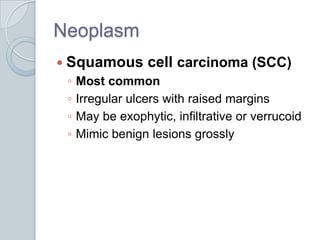 NeoplasmSquamous cell carcinoma (SCC)Most commonIrregular ulcers with raised marginsMay be exophytic, infiltrative or verrucoidMimic benign lesions grossly
