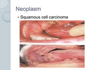 NeoplasmSquamous cell carcinoma