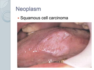 NeoplasmSquamous cell carcinoma