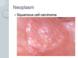 NeoplasmSquamous cell carcinoma