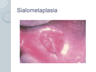 Sialometaplasia
