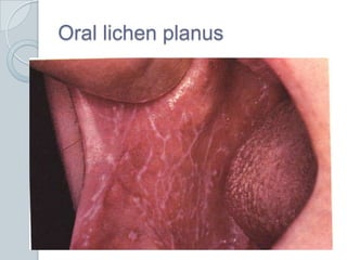 Oral lichen planus