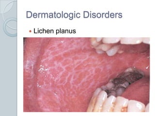 Dermatologic DisordersLichen planus