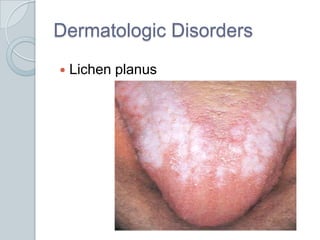 Dermatologic DisordersLichen planus