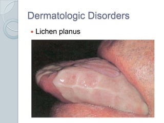 Dermatologic DisordersLichen planus