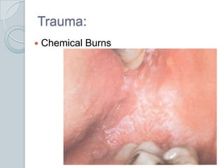 Trauma:<br />Chemical Burns<br />