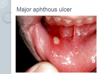 Major aphthous ulcer<br />