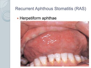 Recurrent Aphthous Stomatitis (RAS)<br />Herpetiform aphthae<br />