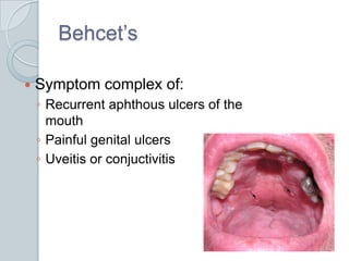 Behcet’s<br />Symptom complex of:<br />Recurrent aphthous ulcers of the mouth<br />Painful genital ulcers<br />Uveitis or ...