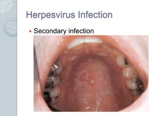 Herpesvirus Infection<br />Secondary infection<br />