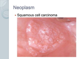 Neoplasm<br />Squamous cell carcinoma<br />
